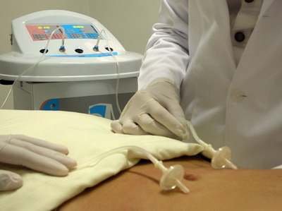 Carboxiterapia