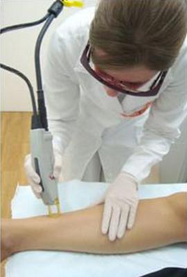 Depilação a laser