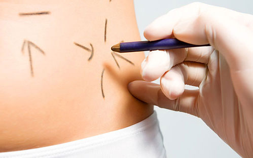 Lipoaspiração Preço