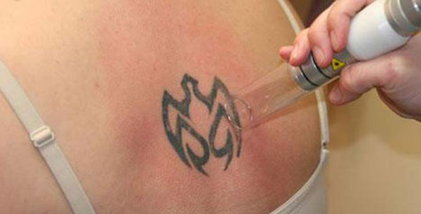 Remoção de Tatuagem a Laser