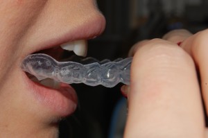 Foto de Clareamento Dental Caseiro com Moldeira