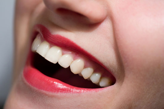 Foto depois do Clareamento Dental