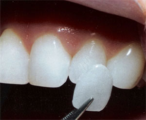 Lente de Contato Dental