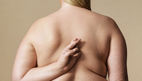 Cirurgia Bariátrica pelo SUS