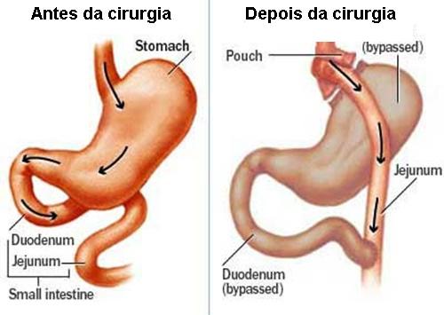 Cirurgia Bariátrica pelo SUS
